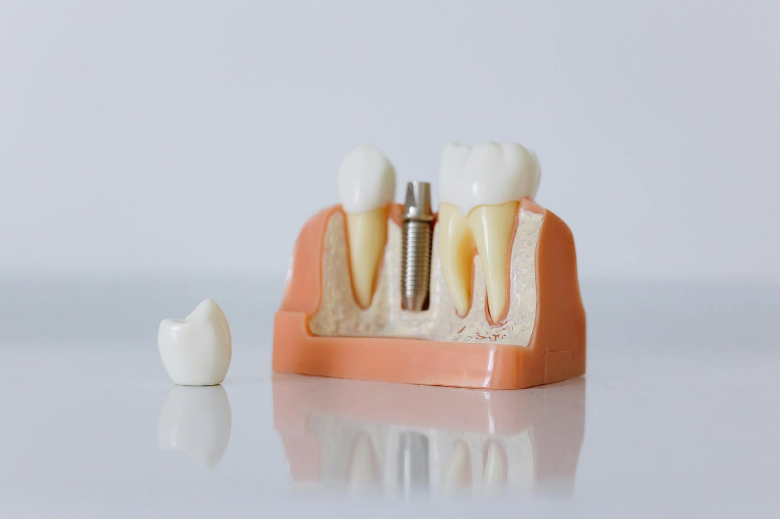 Illustration of Implant Lifespan Jaipur: Stunning Dental Implants That Last Effortlessly